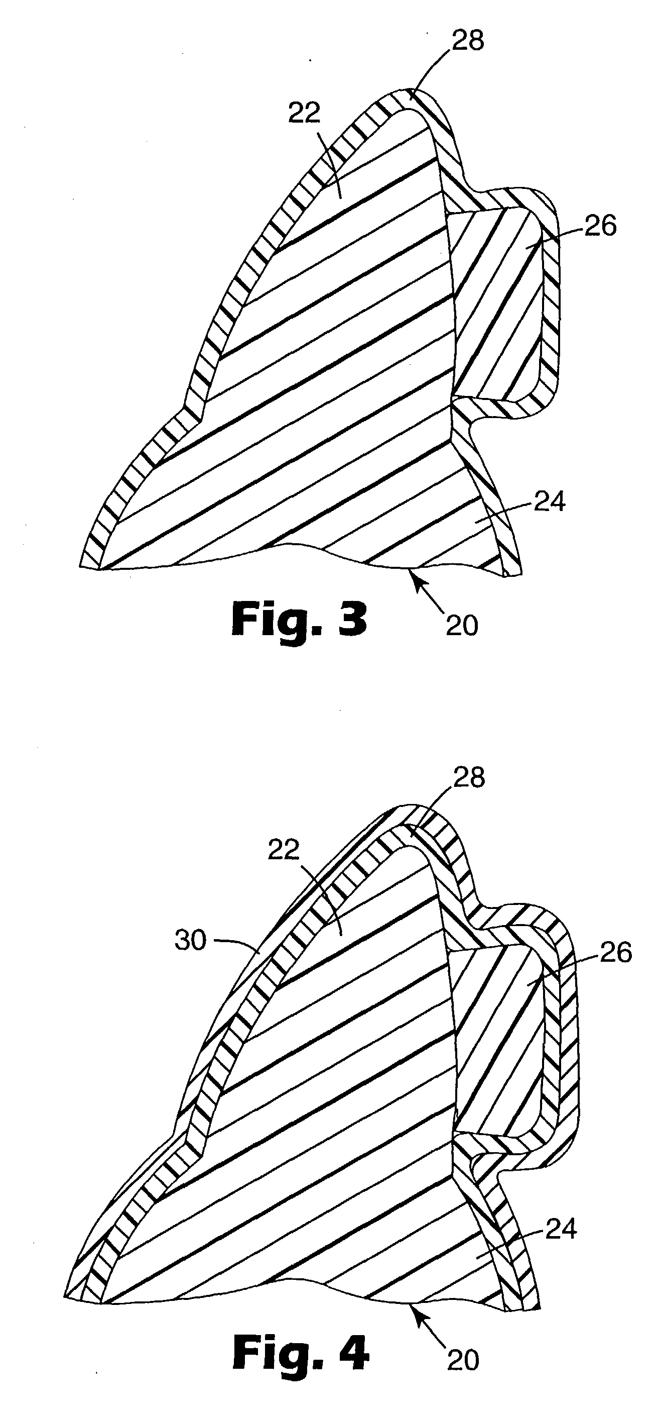 Orthodontic appliances having a contoured bonding surface