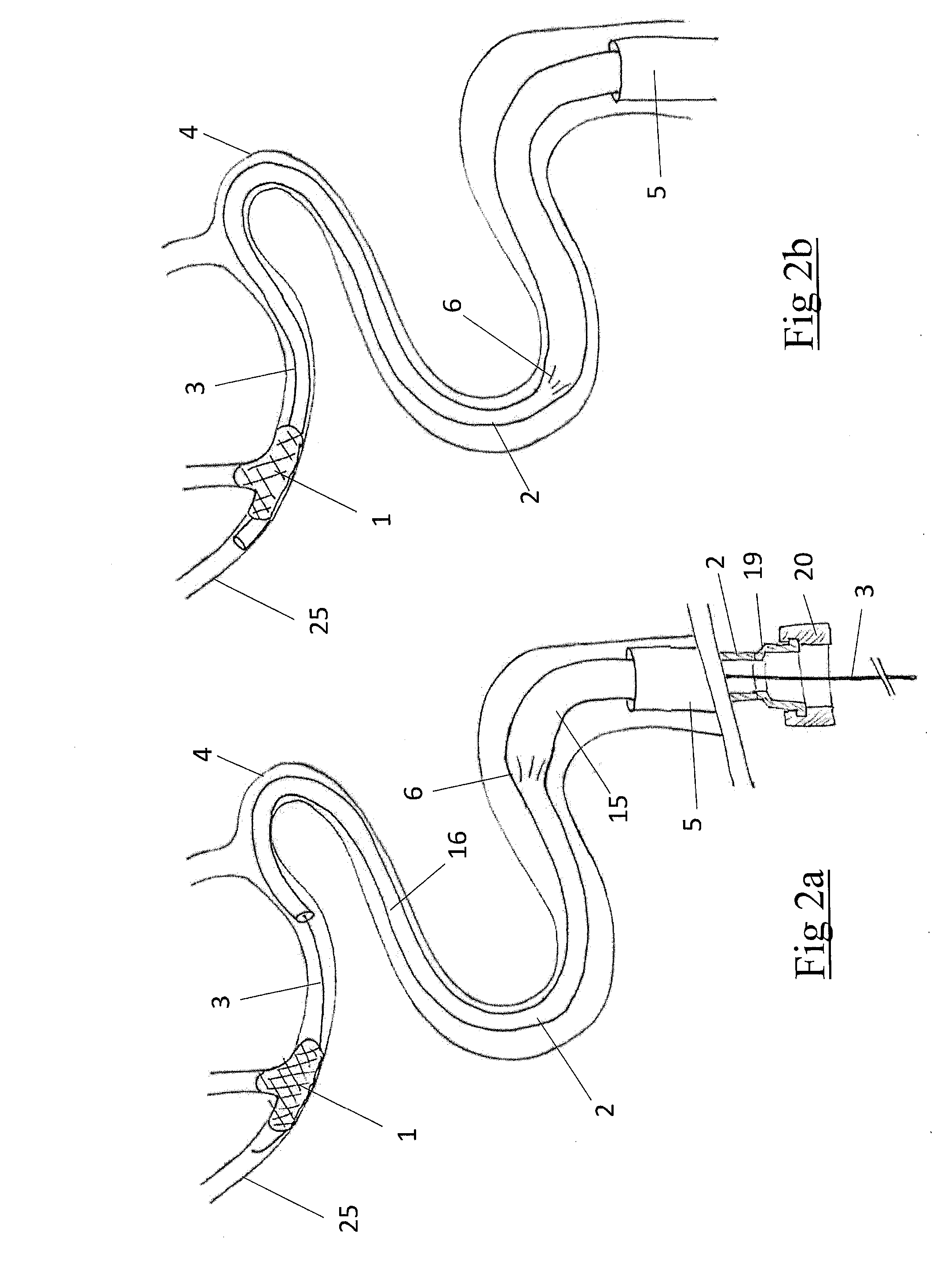 System for removing a clot from a blood vessel