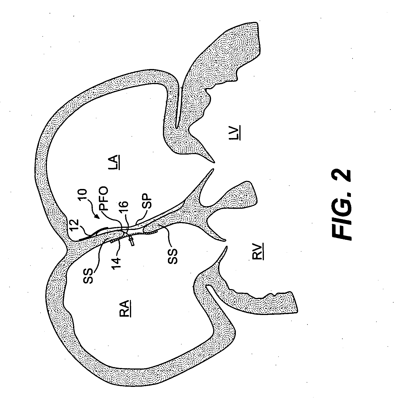 Closure devices, related delivery methods, and related methods of use