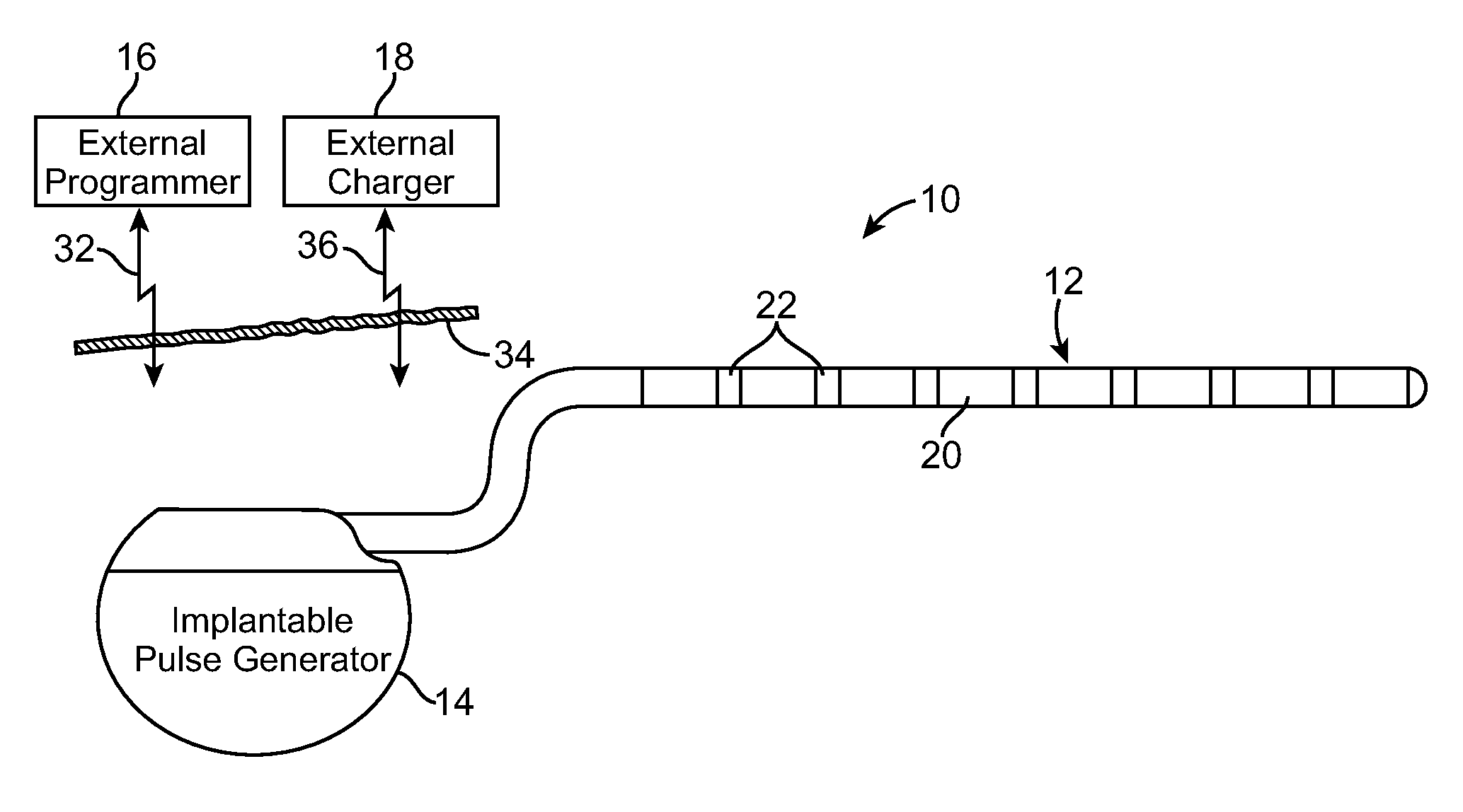 Moldable charger with shape-sensing means for an implantable pulse generator