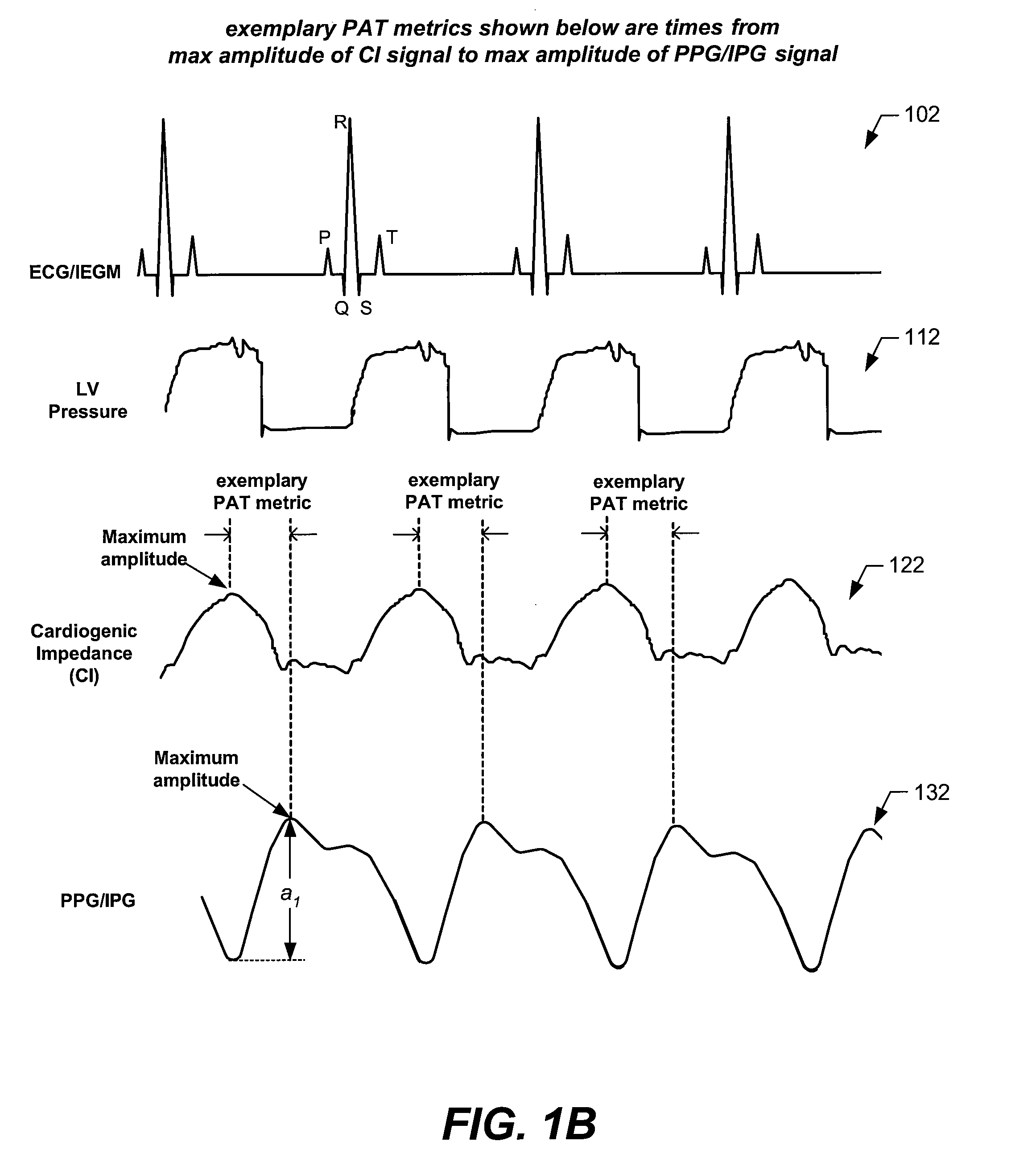 Arterial blood pressure monitoring devices, systems and methods using cardiogenic impedance signal