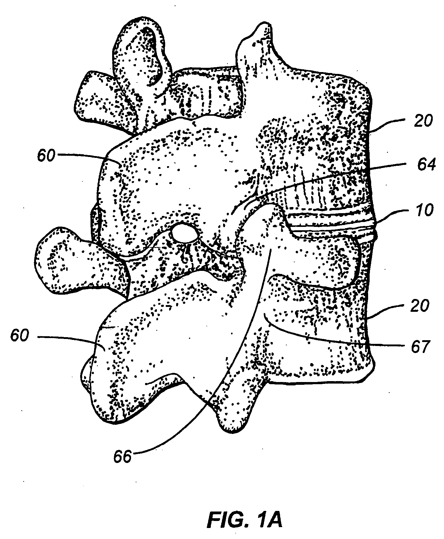 Percutaneous endoscopic access tools for the spinal epidural space and related methods of treatment