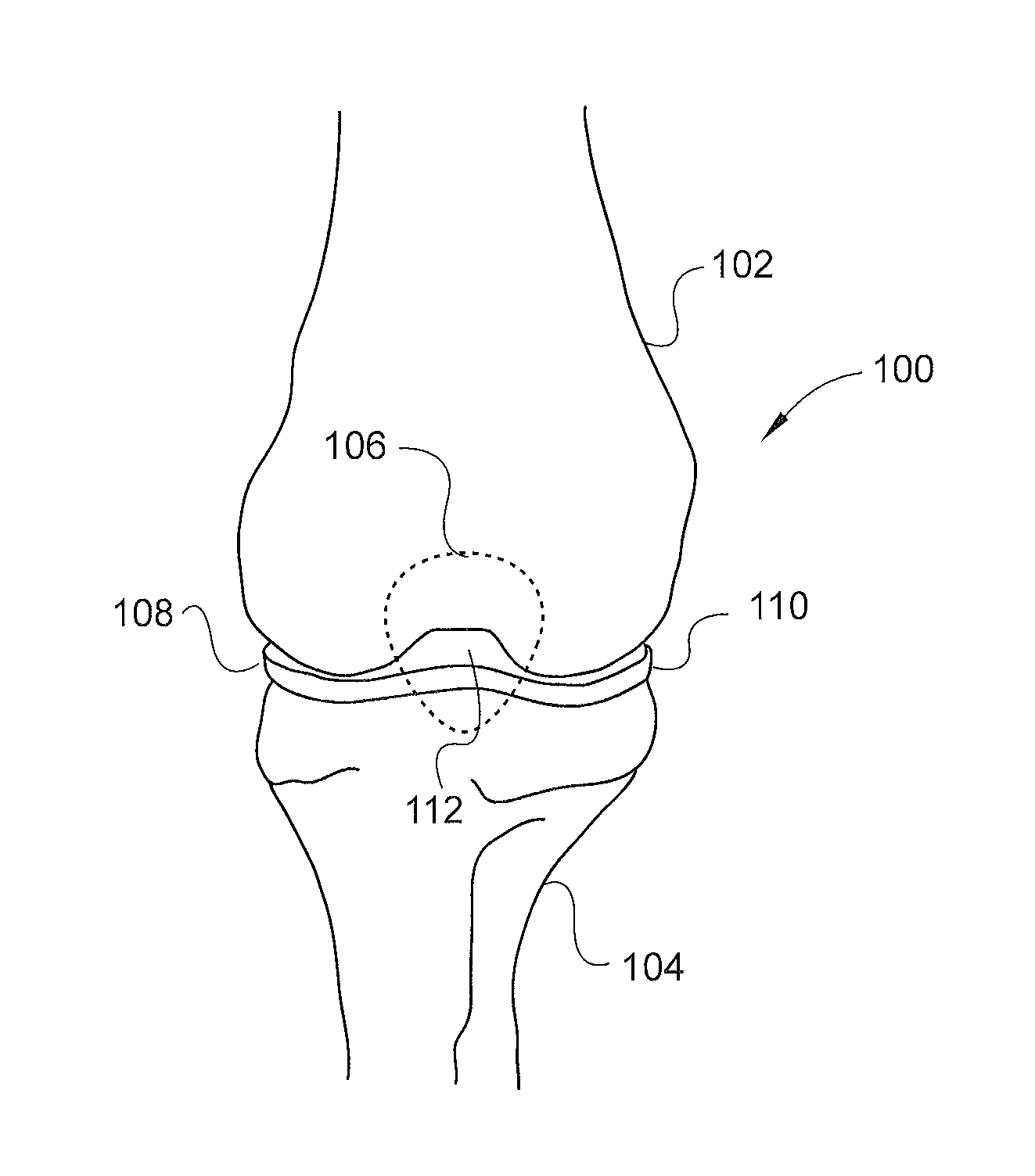 Combinatorial therapy for treatment of osteoarthritis of the knee