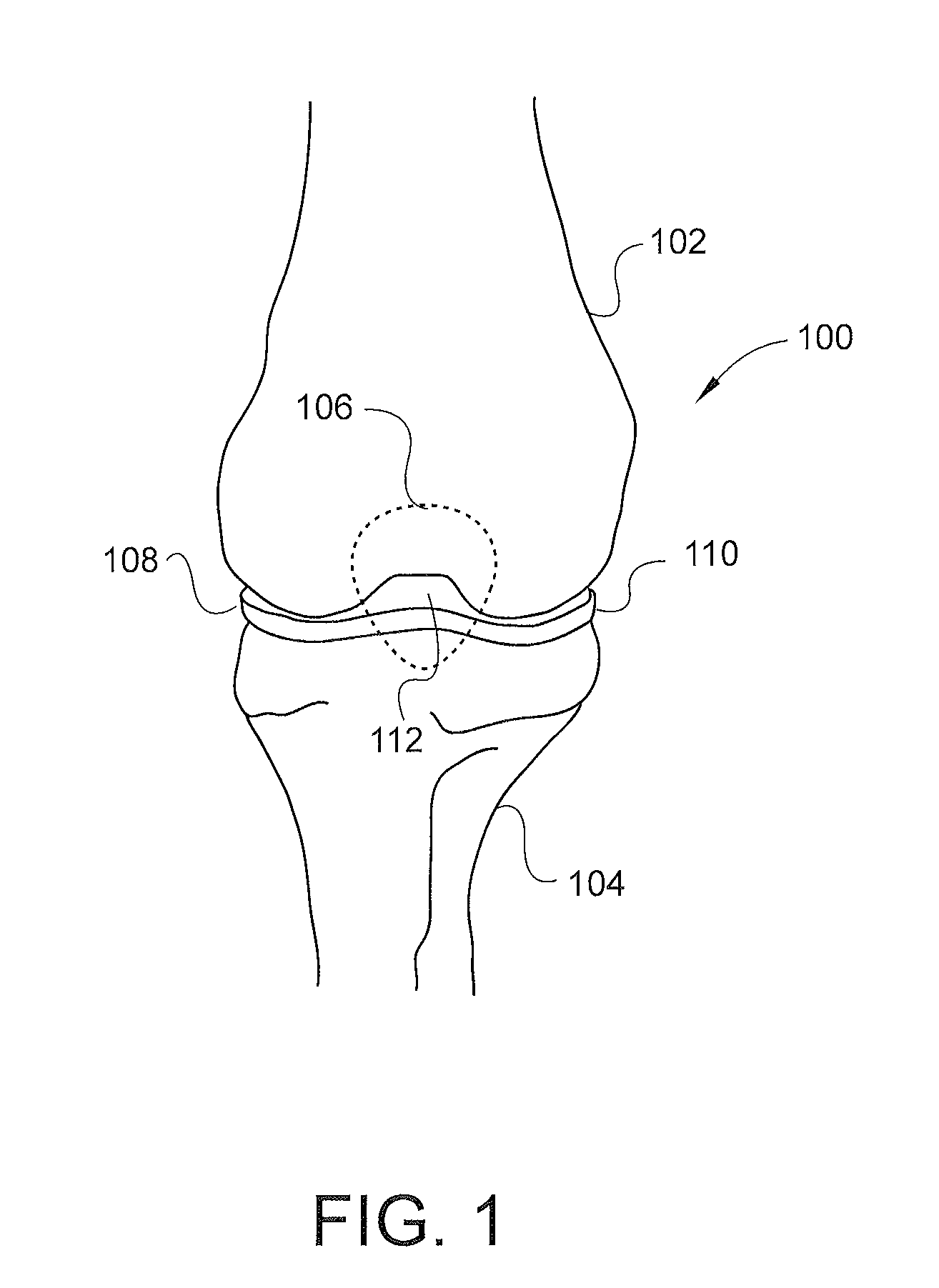 Combinatorial therapy for treatment of osteoarthritis of the knee