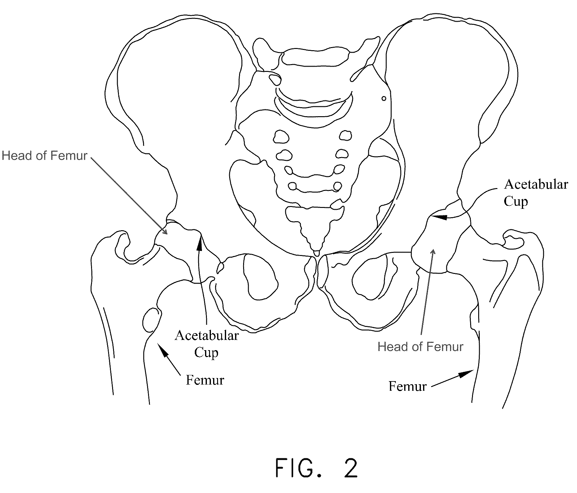 Method and apparatus for passing suture through the labrum of a hip joint in order to secure the labrum to the acetabulum