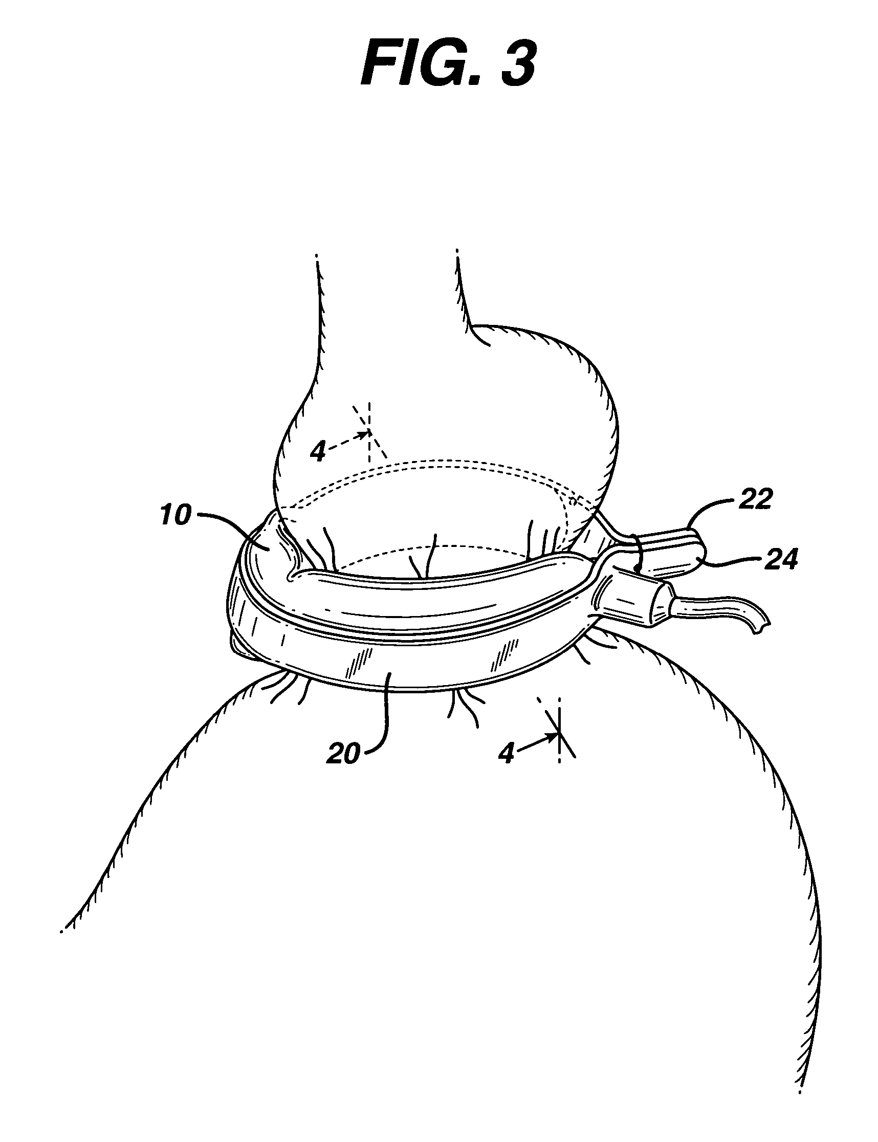 Surgically implantable adjustable band having a flat profile when implanted