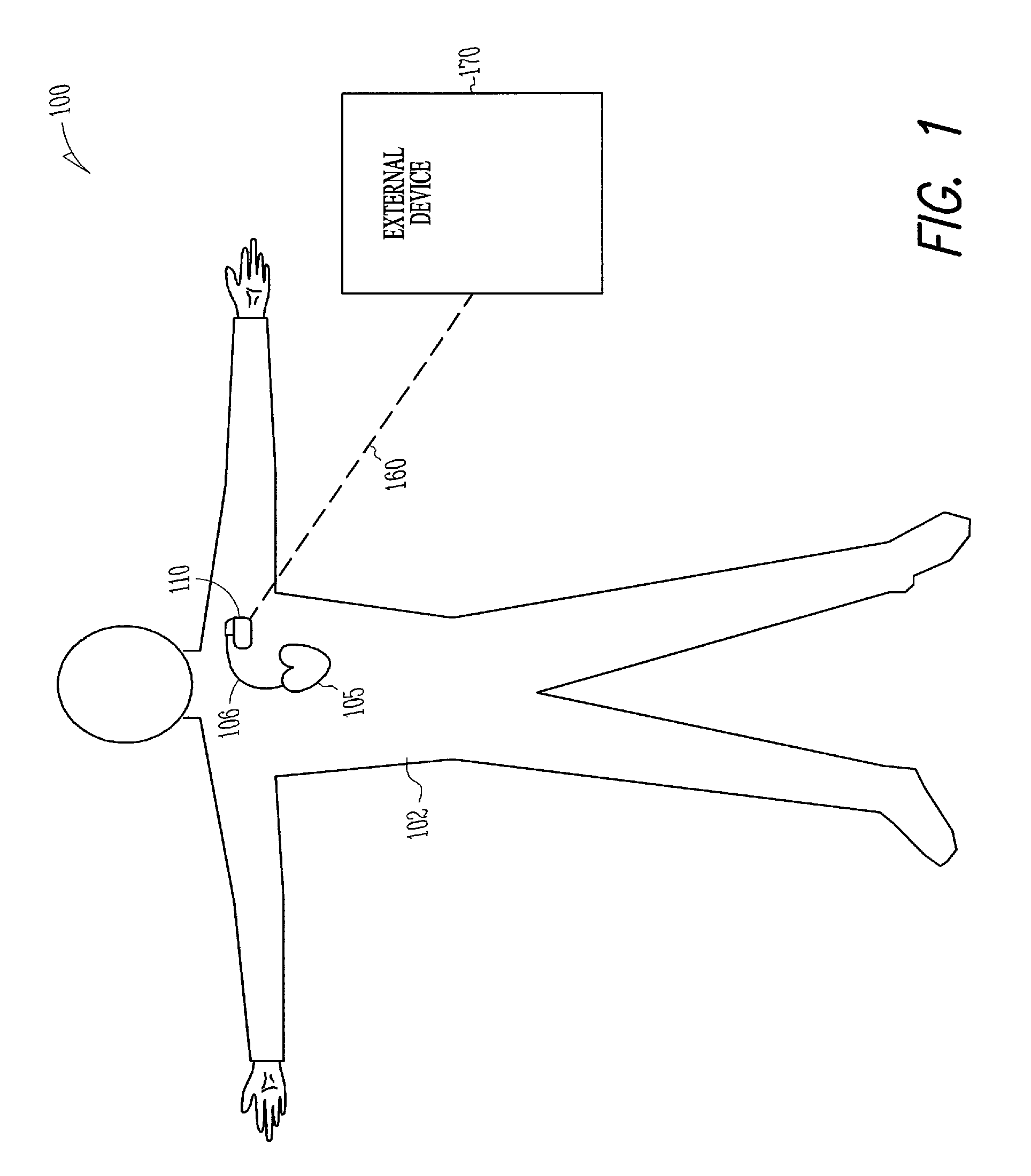 Therapy control based on the rate of change of intracardiac impedance