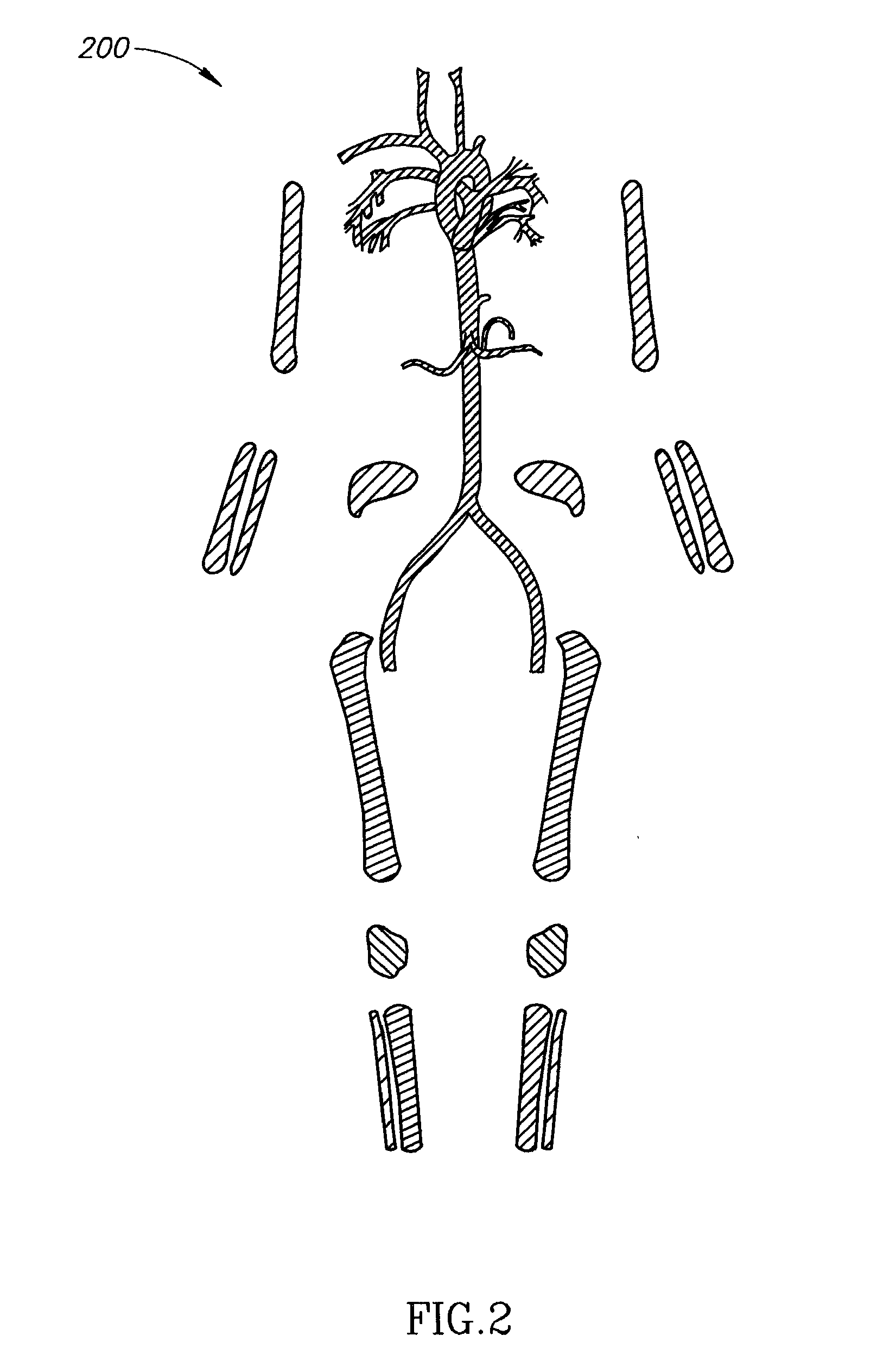 Bone segmentation