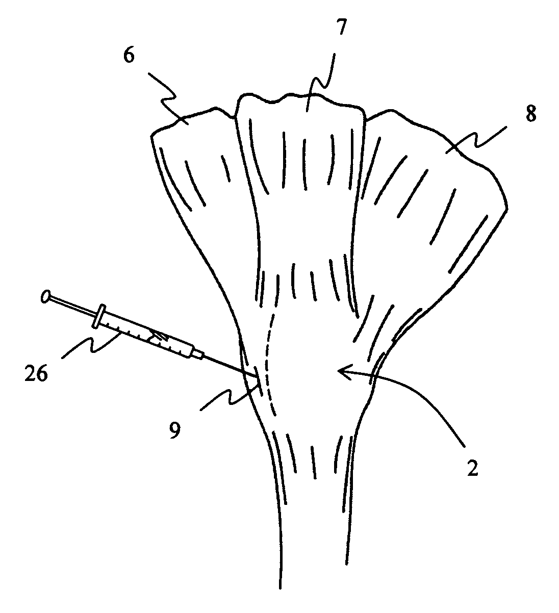 Method for treating patella subluxation