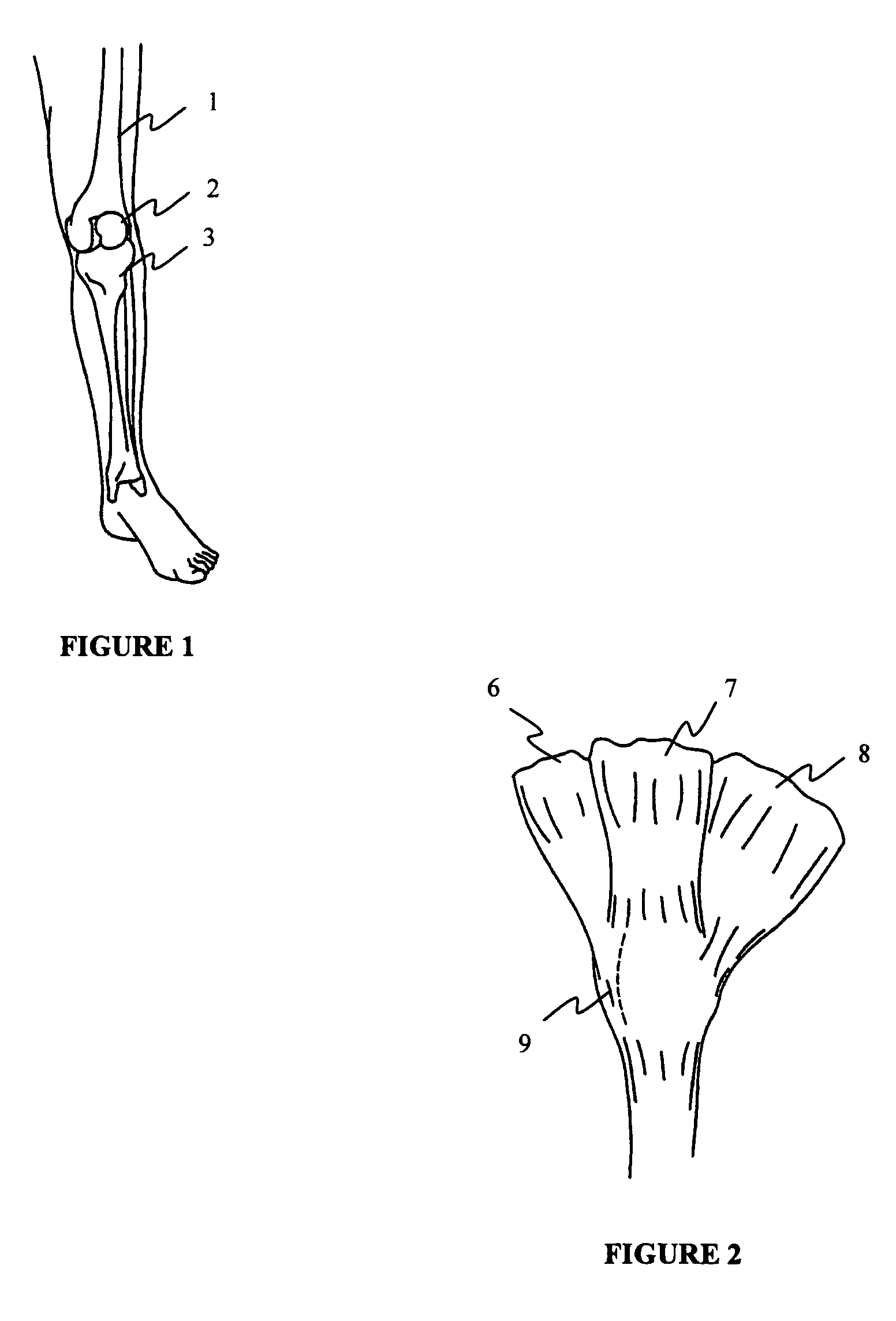 Method for treating patella subluxation