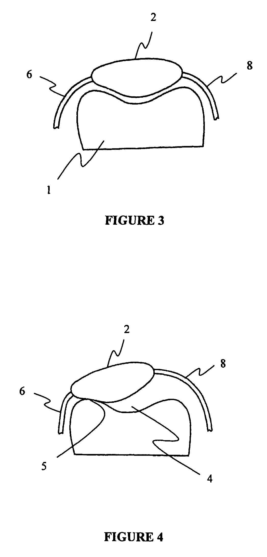 Method for treating patella subluxation