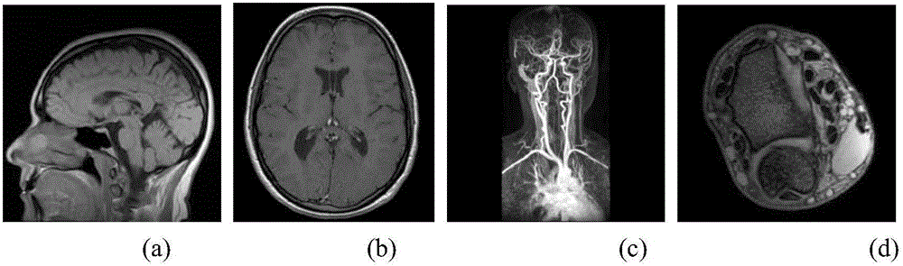 Fast iterative magnetic resonance image reconstruction method based on high-order total variation regularization