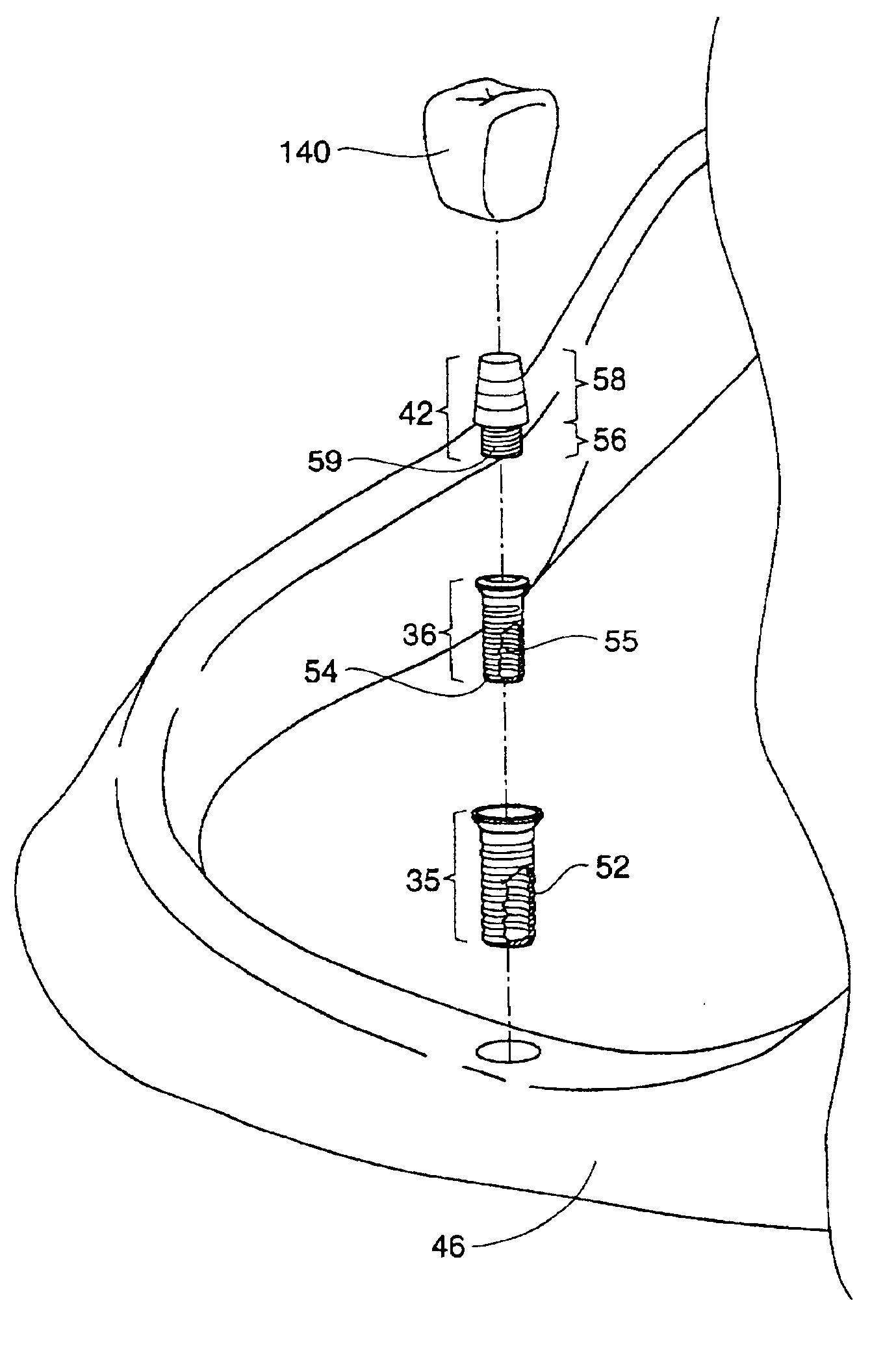 Expandable polymer dental implant and method of use