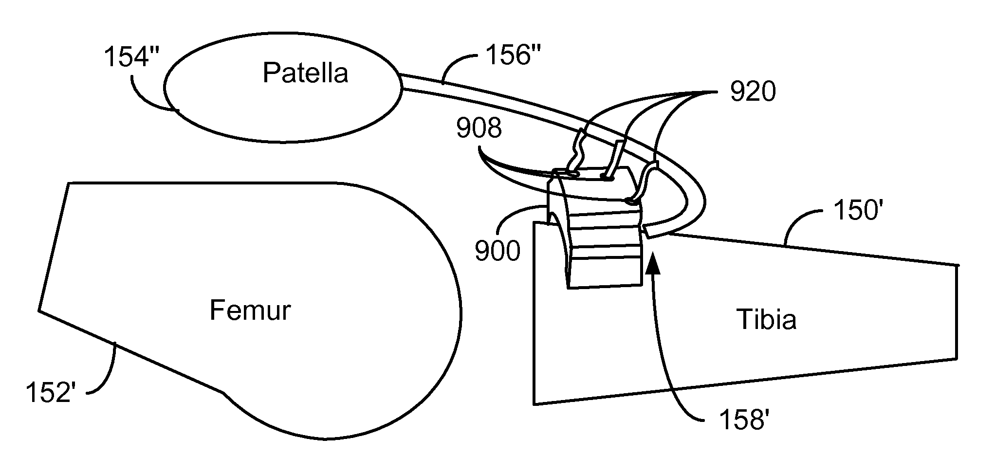 Method and system for patella tendon realignment