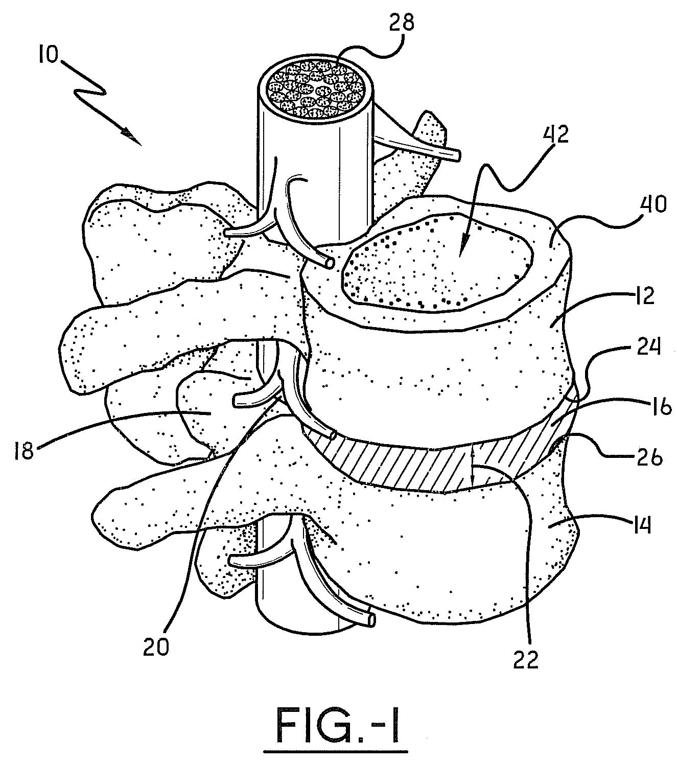 Spine surgery method and instrumentation