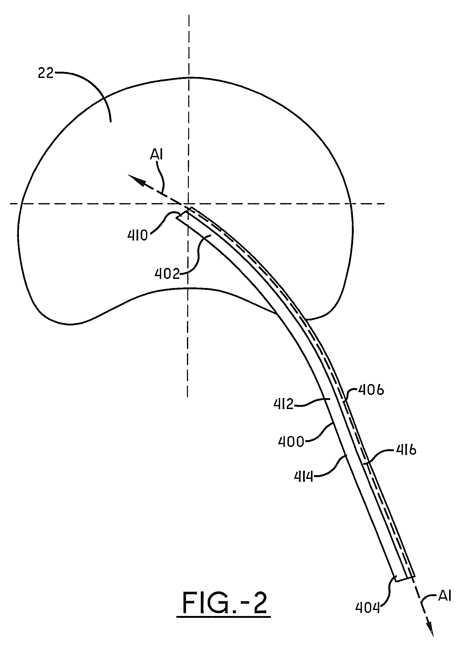 Spine surgery method and instrumentation