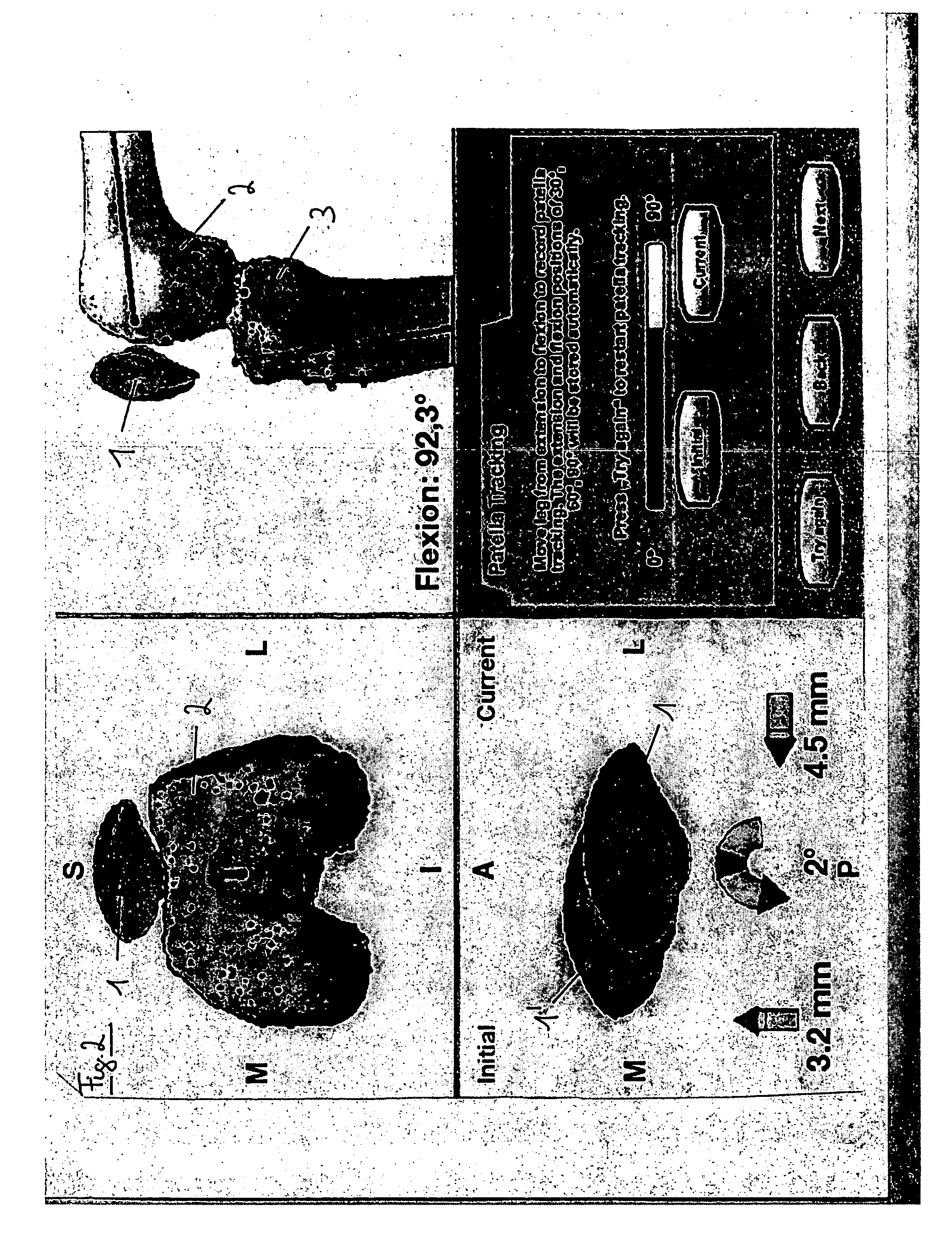 Planning method and planning device for knee implants