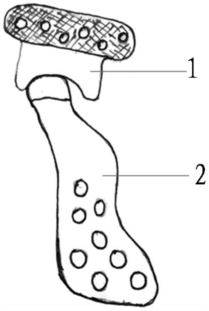 An artificial temporomandibular joint replacement prosthesis