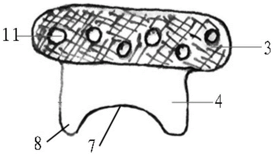 An artificial temporomandibular joint replacement prosthesis