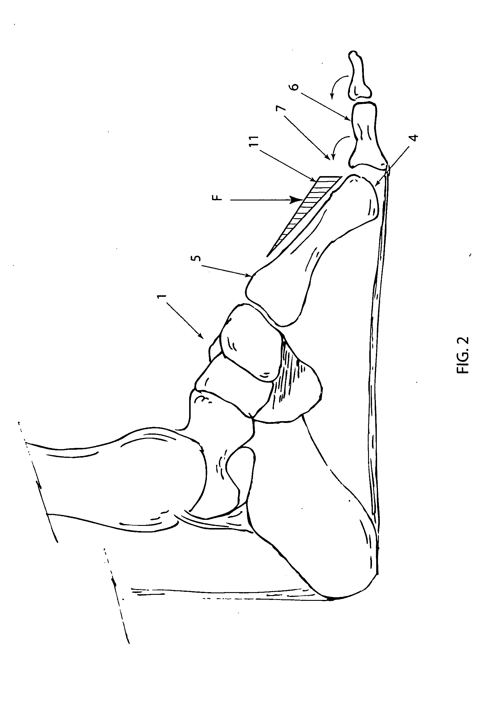 Orthotic device and method of use