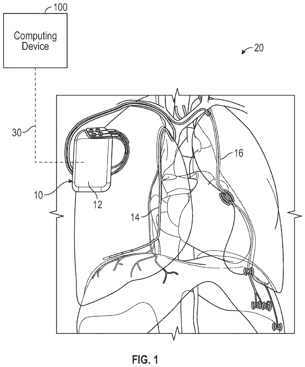 Monitoring system and user interface for monitoring implantable disordered breathing treatment systems