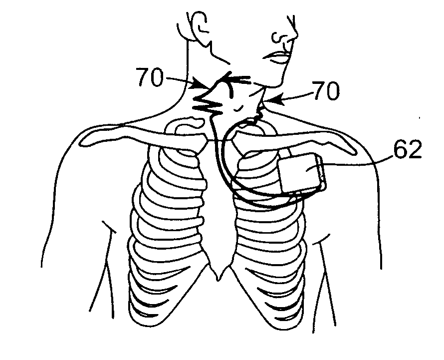 Implantable medical lead assemblies with improved flexibility and extensibility and having a substantially two-dimensional nature