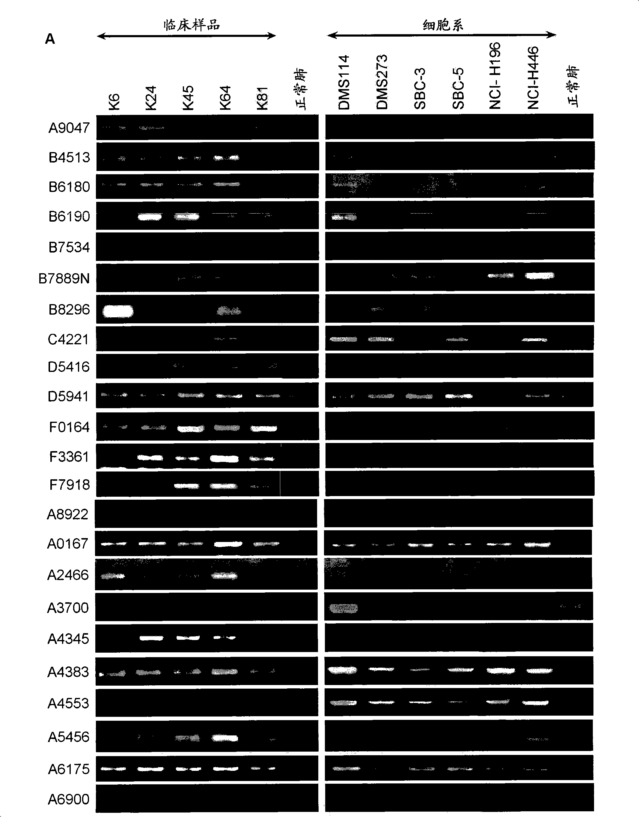 Method of diagnosing small cell lung cancer