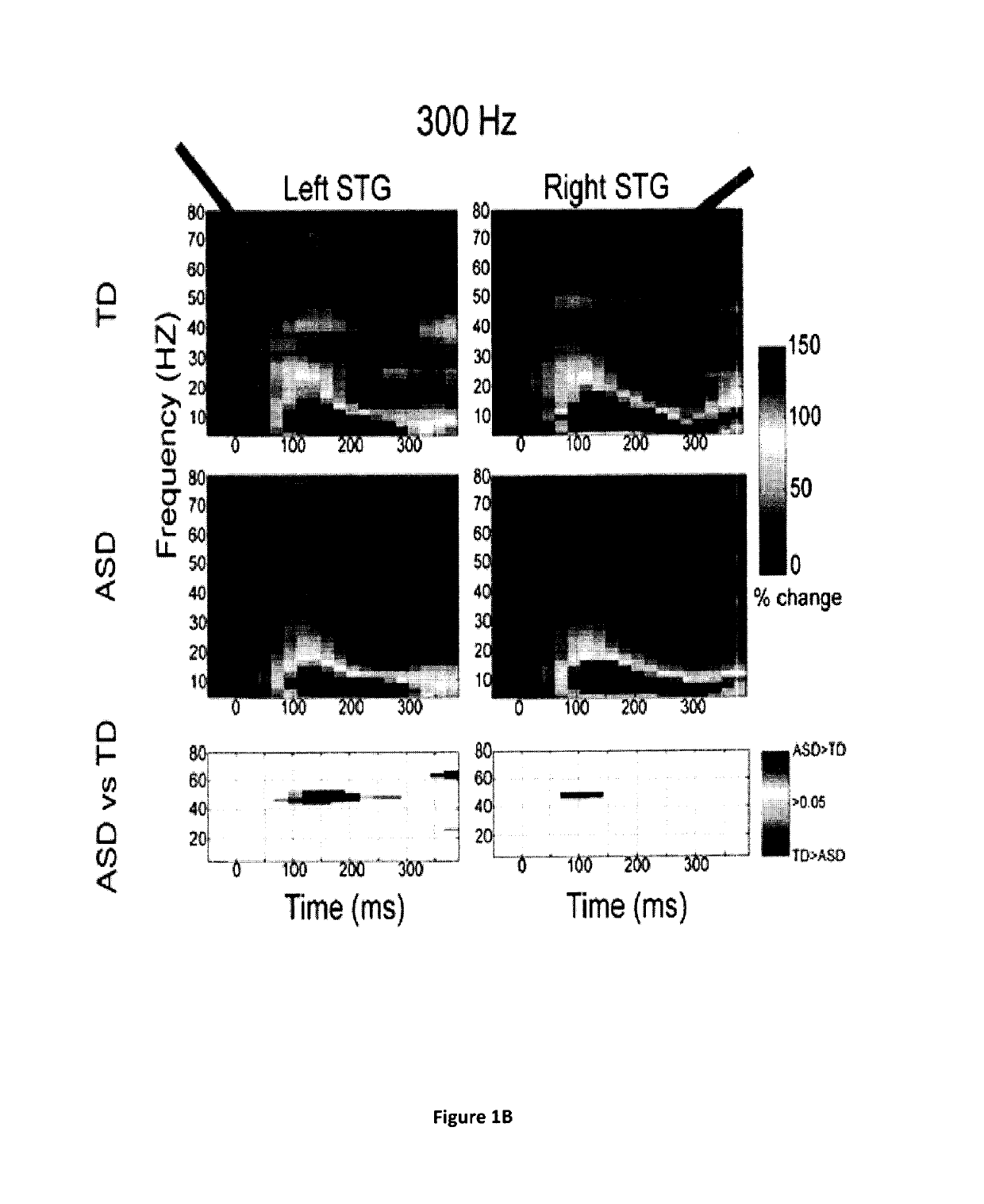 Magnetoencephalography biomarkers of GABA-B agonist drug activity in autism spectrum disorders