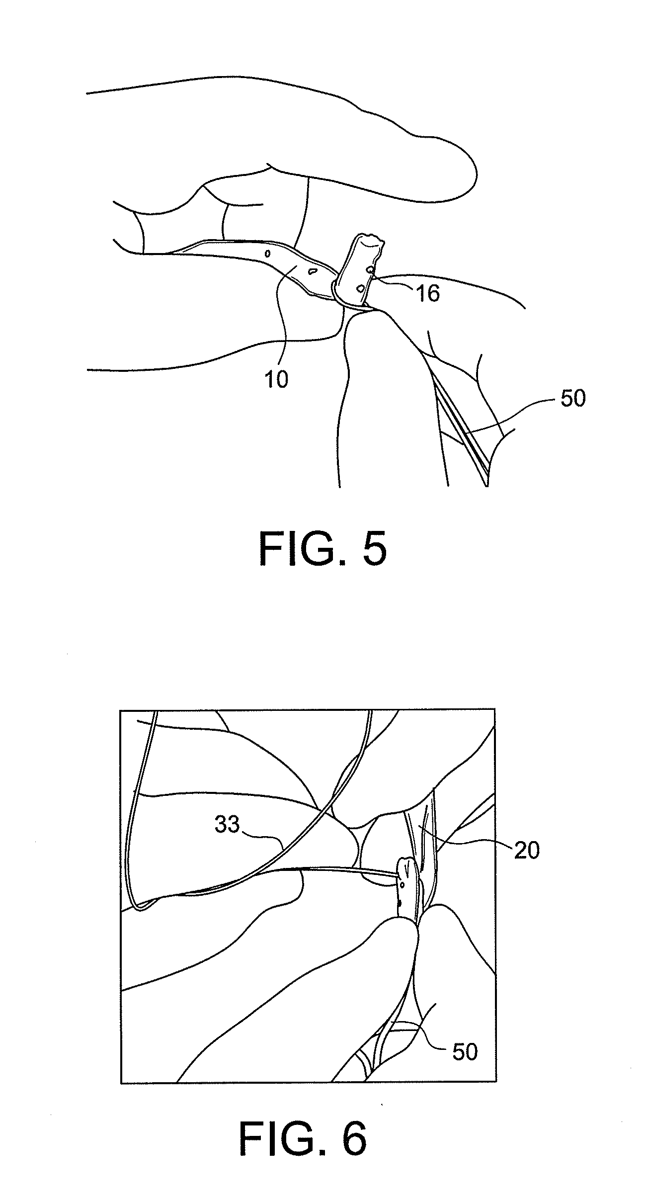 Bone tendon constructs and methods of tissue fixation