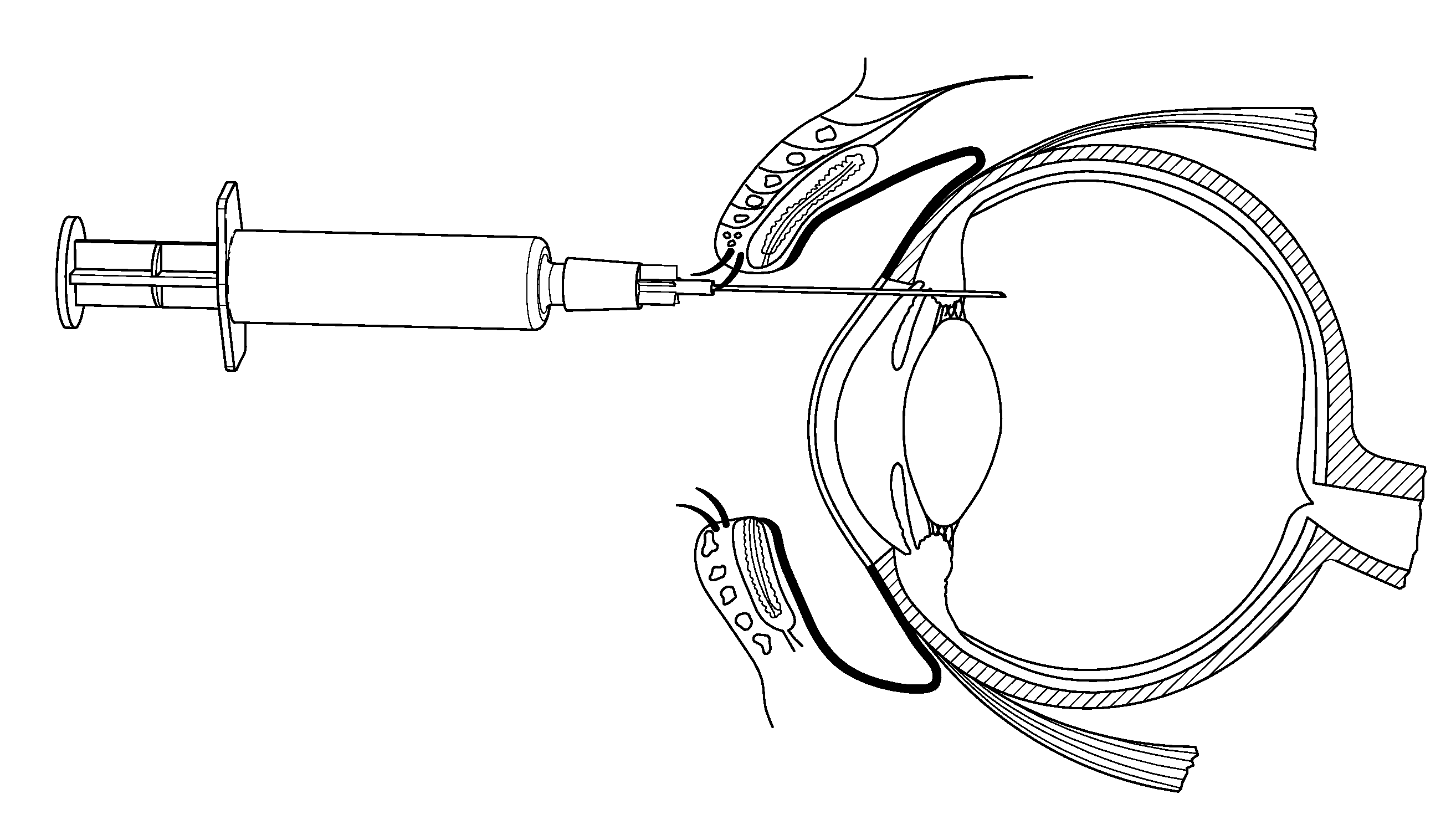 Method of treating AMD in patients refractory to Anti-vegf therapy