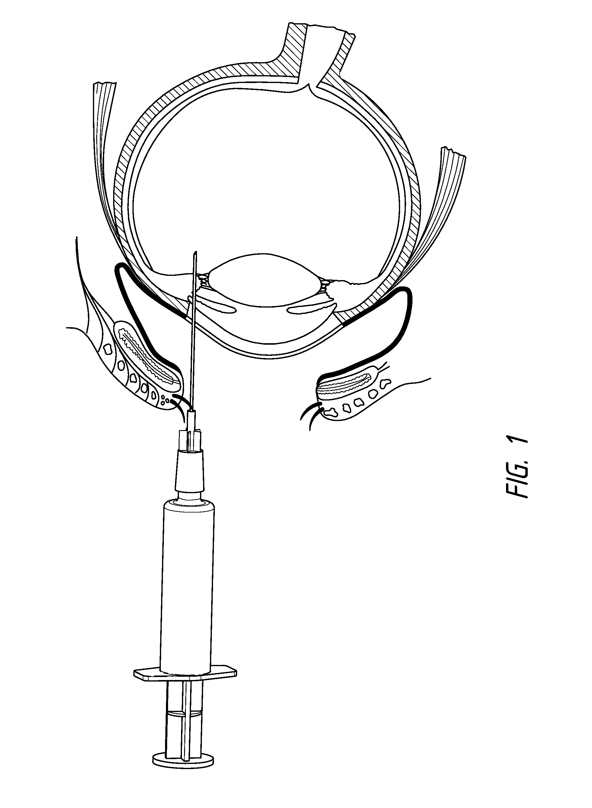 Method of treating AMD in patients refractory to Anti-vegf therapy