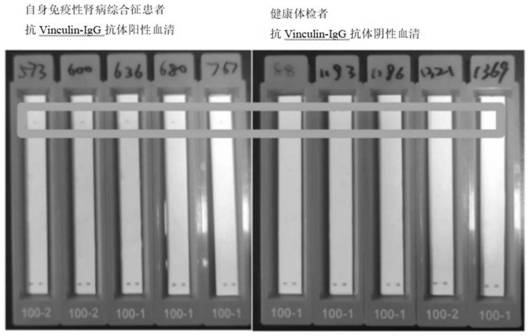 A kit for detecting anti-vinculin-igg antibody