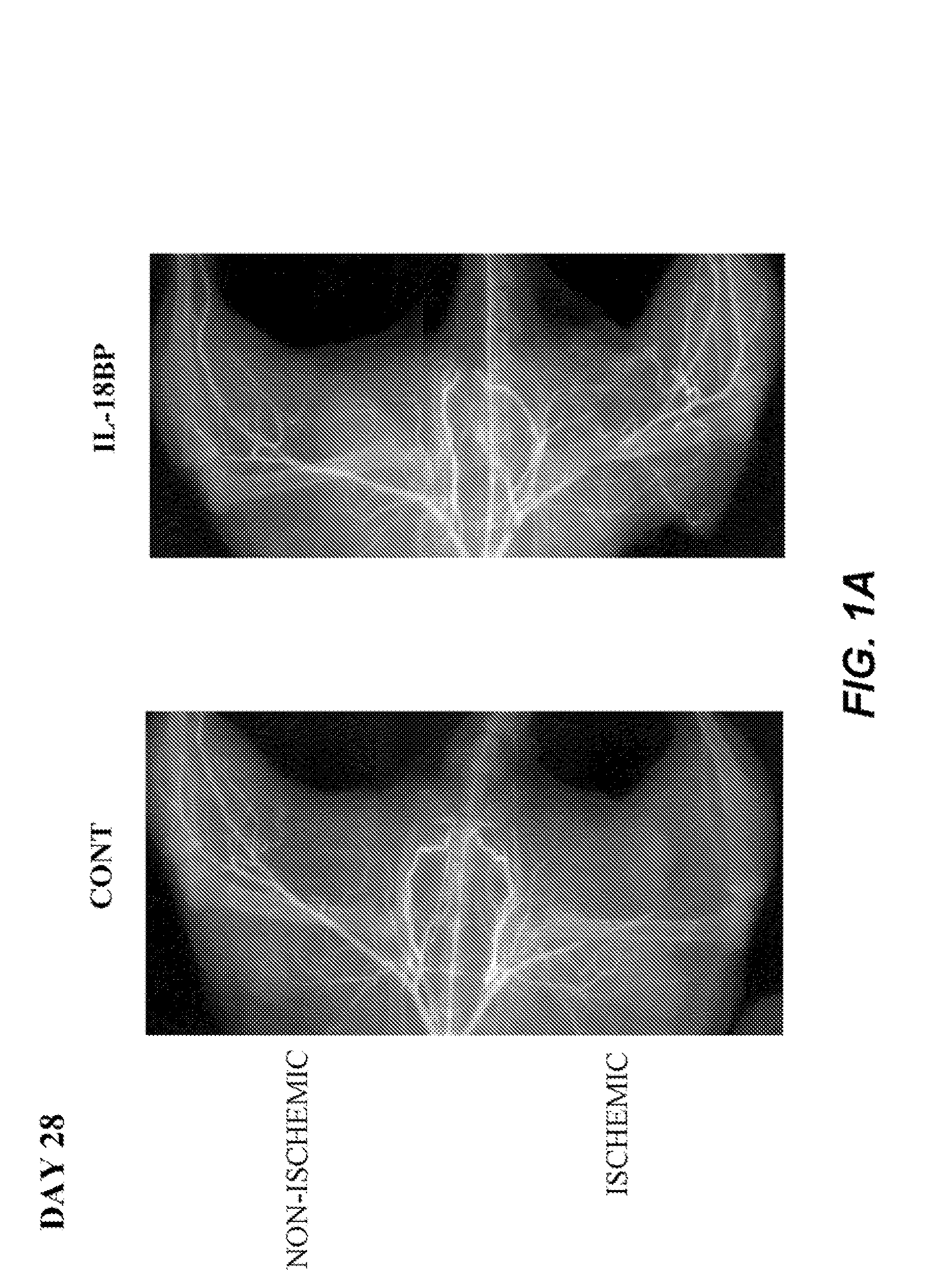 Method of treating peripheral vascular diseases using IL-18 inhibitors