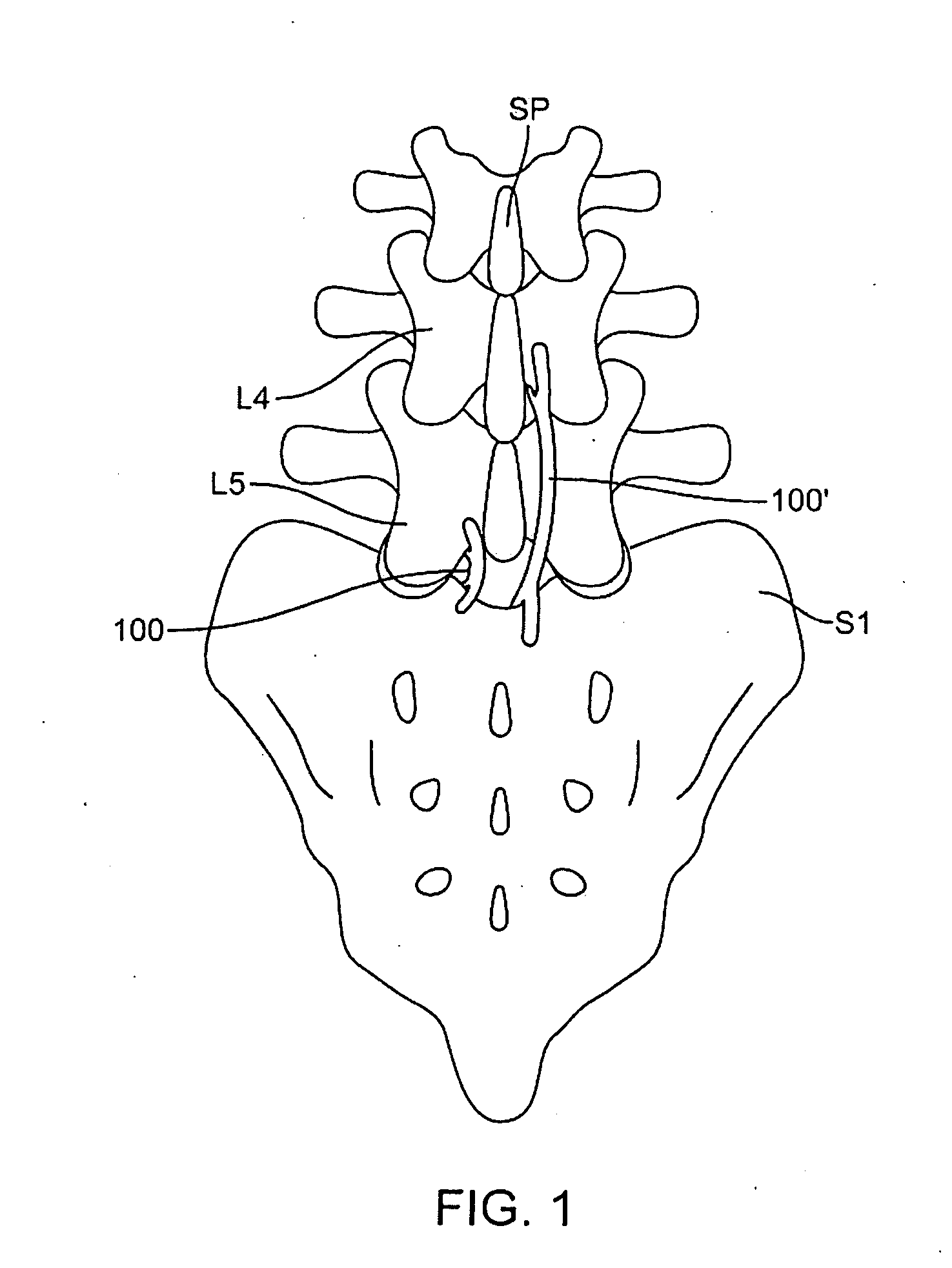 Surgical method and apparatus for treating spinal stenosis and stabilization of vertebrae