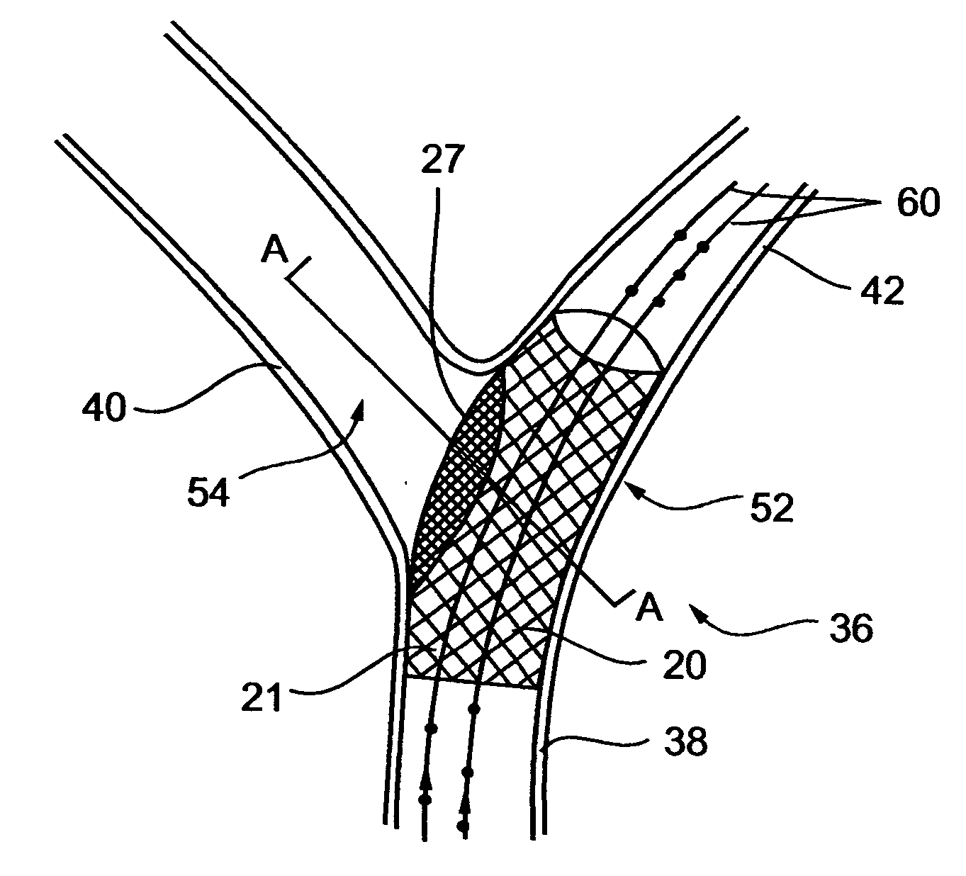 Implantable integral device and corresponding method for deflecting embolic material in blood flowing at an arterial bifurcation