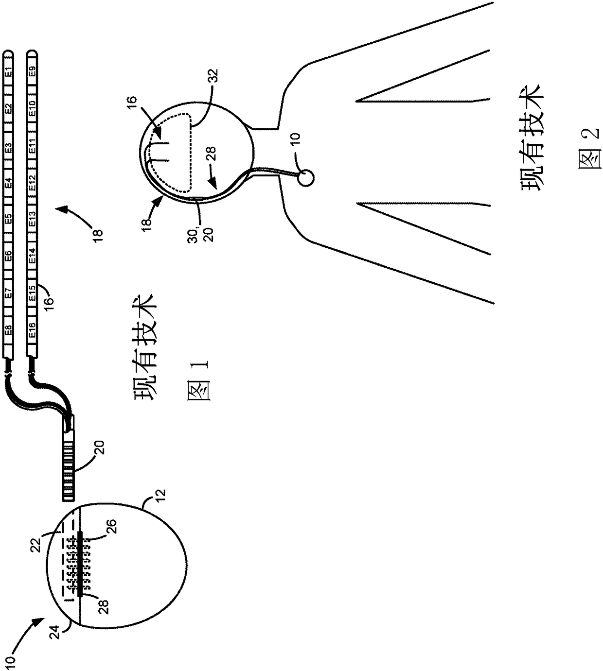 Skull-mounted deep brain stimulator