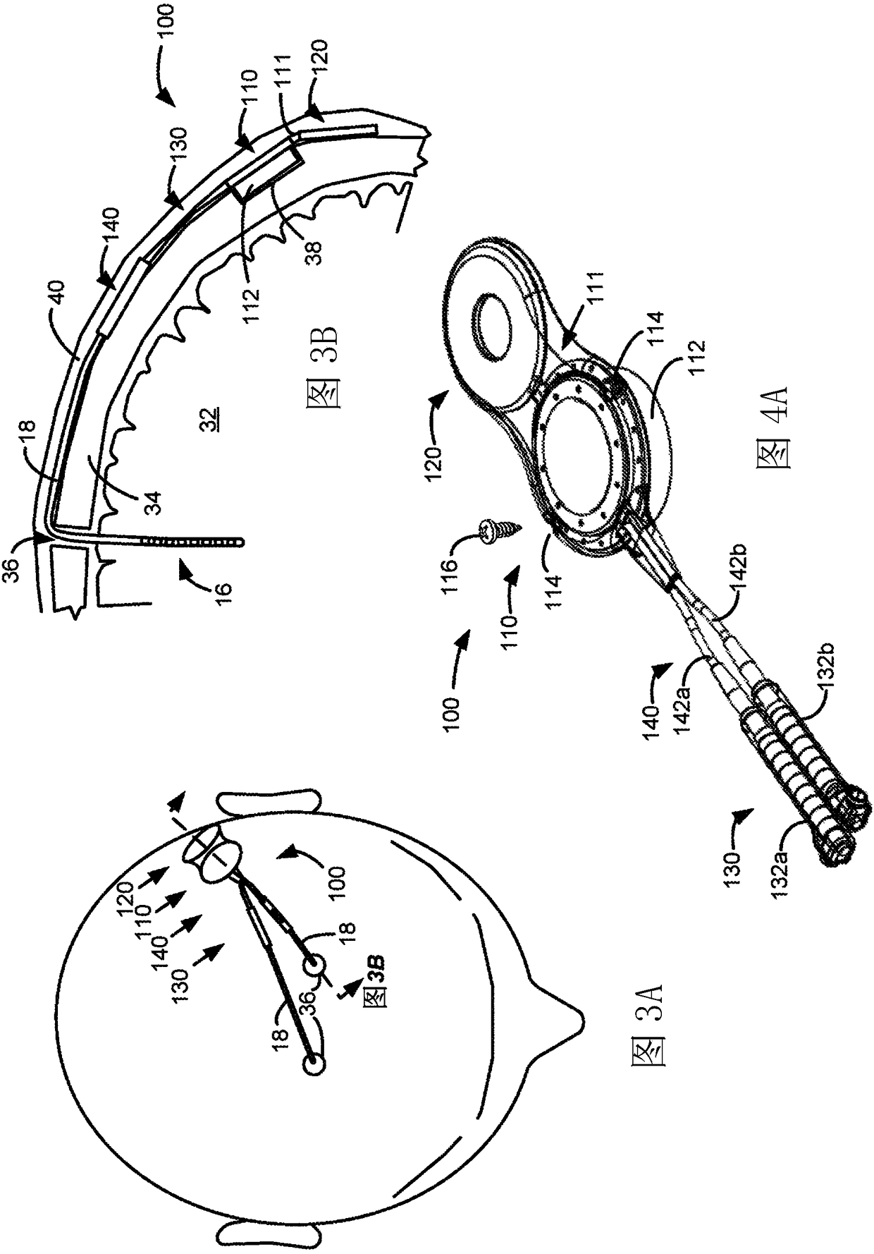 Skull-mounted deep brain stimulator