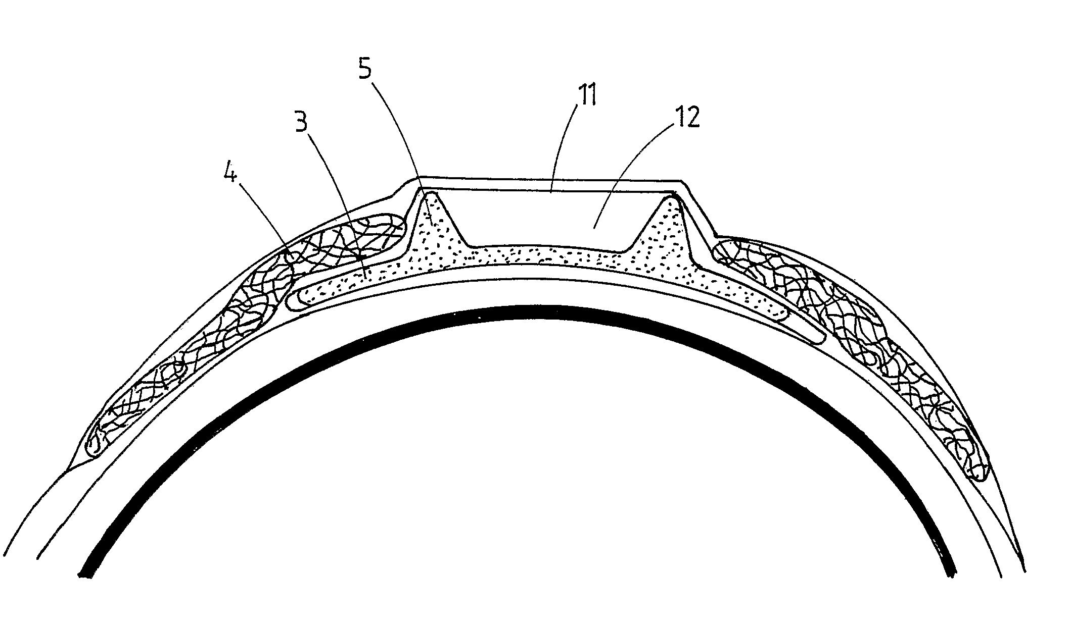 Ophthalmic implant for treating glaucoma