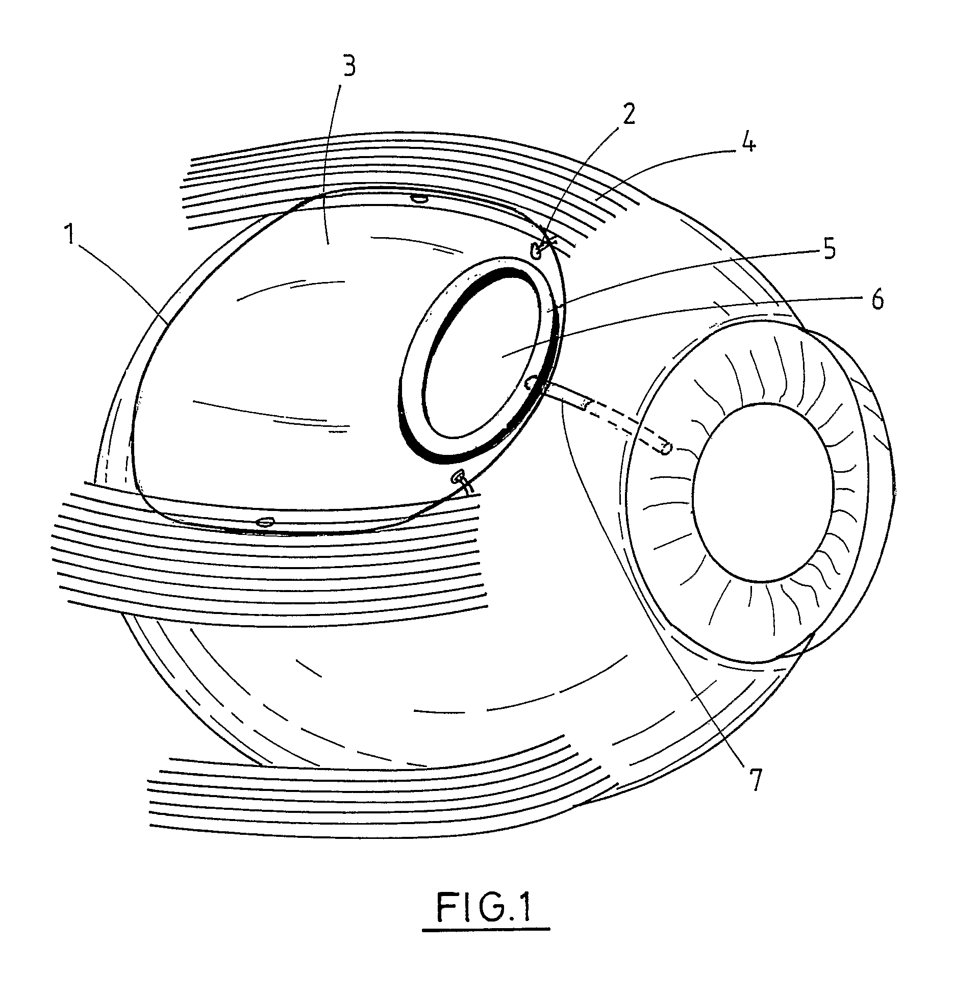 Ophthalmic implant for treating glaucoma