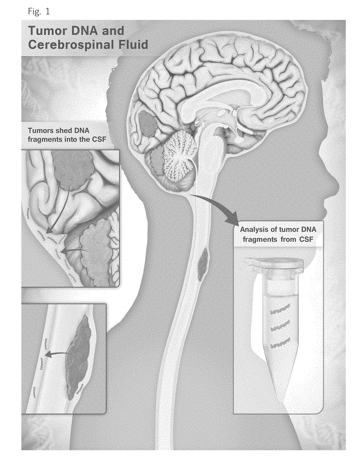 Detection of tumor-derived DNA in cerebrospinal fluid