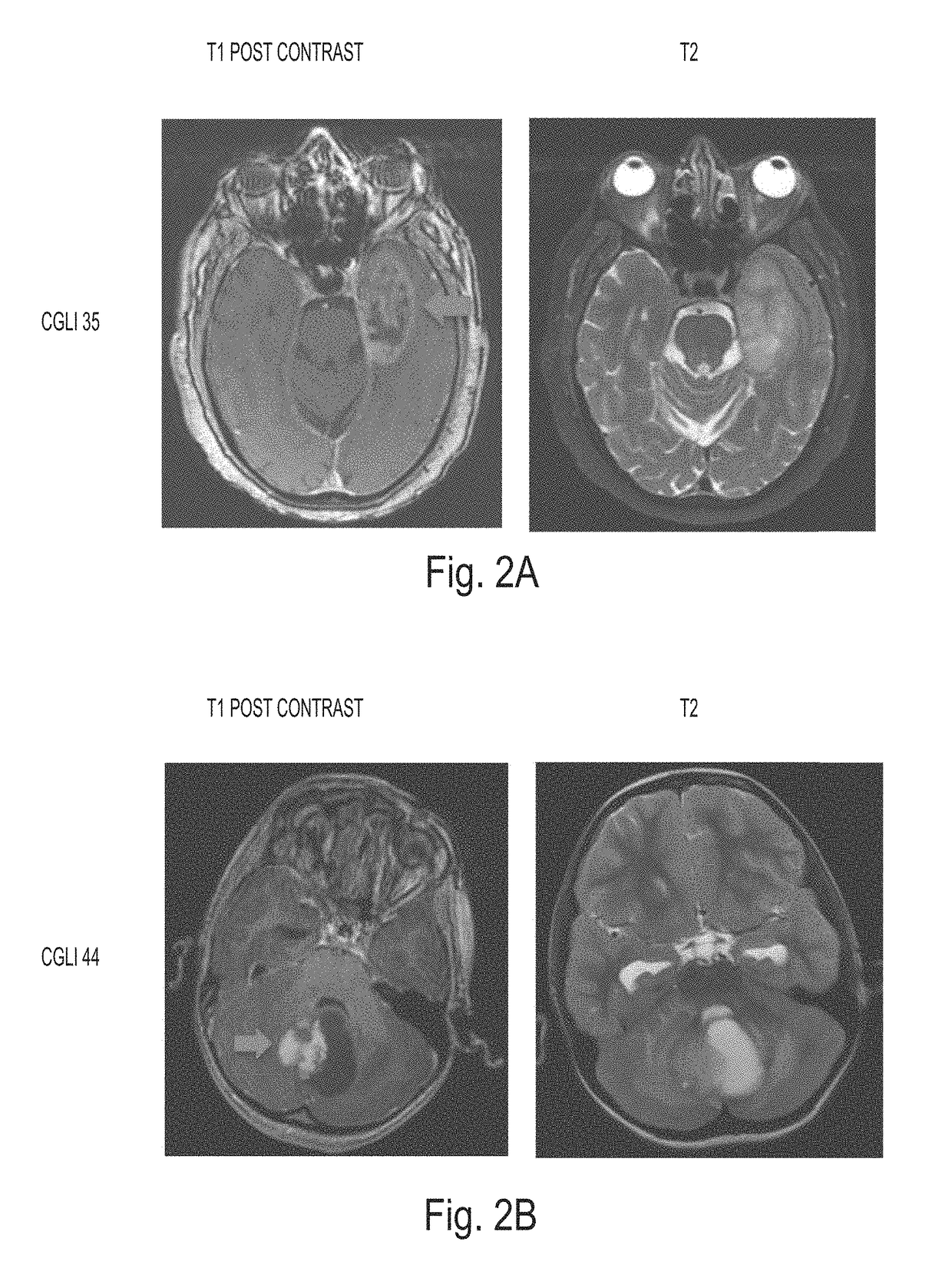 Detection of tumor-derived DNA in cerebrospinal fluid