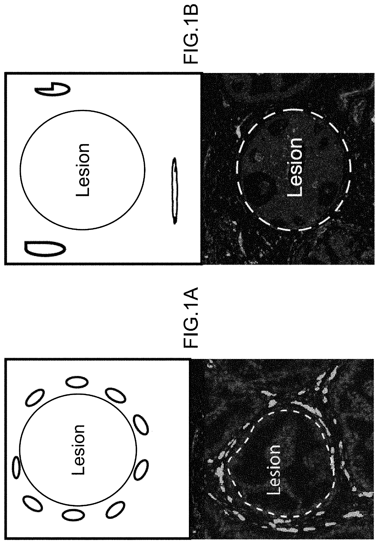 Cancer Progression Risk Assessment by Microvascular Phenotype