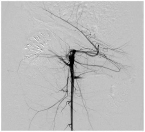 A kind of emulsified lipiodol vascular embolism material and its preparation method and application