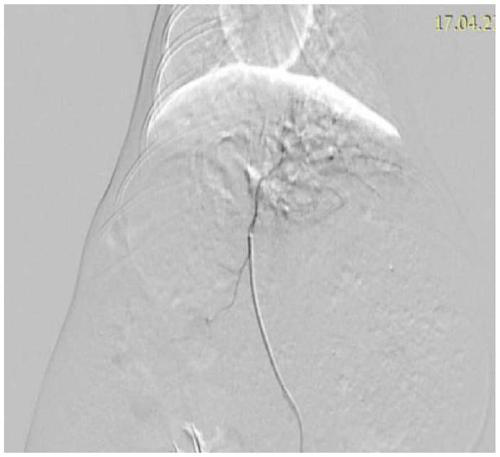 A kind of emulsified lipiodol vascular embolism material and its preparation method and application