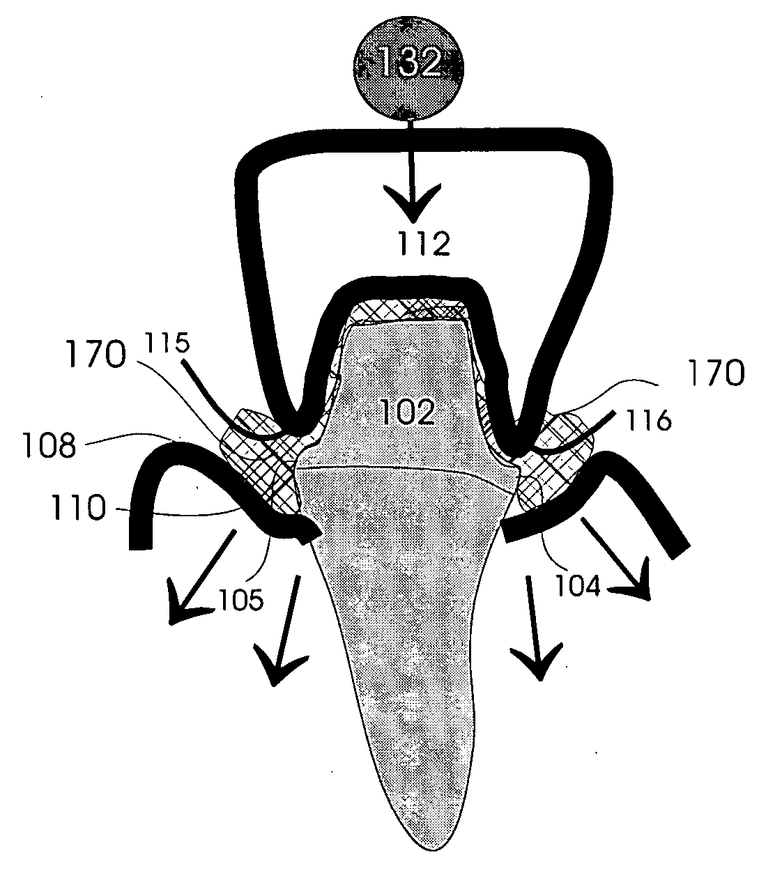 Gingival retraction device and method