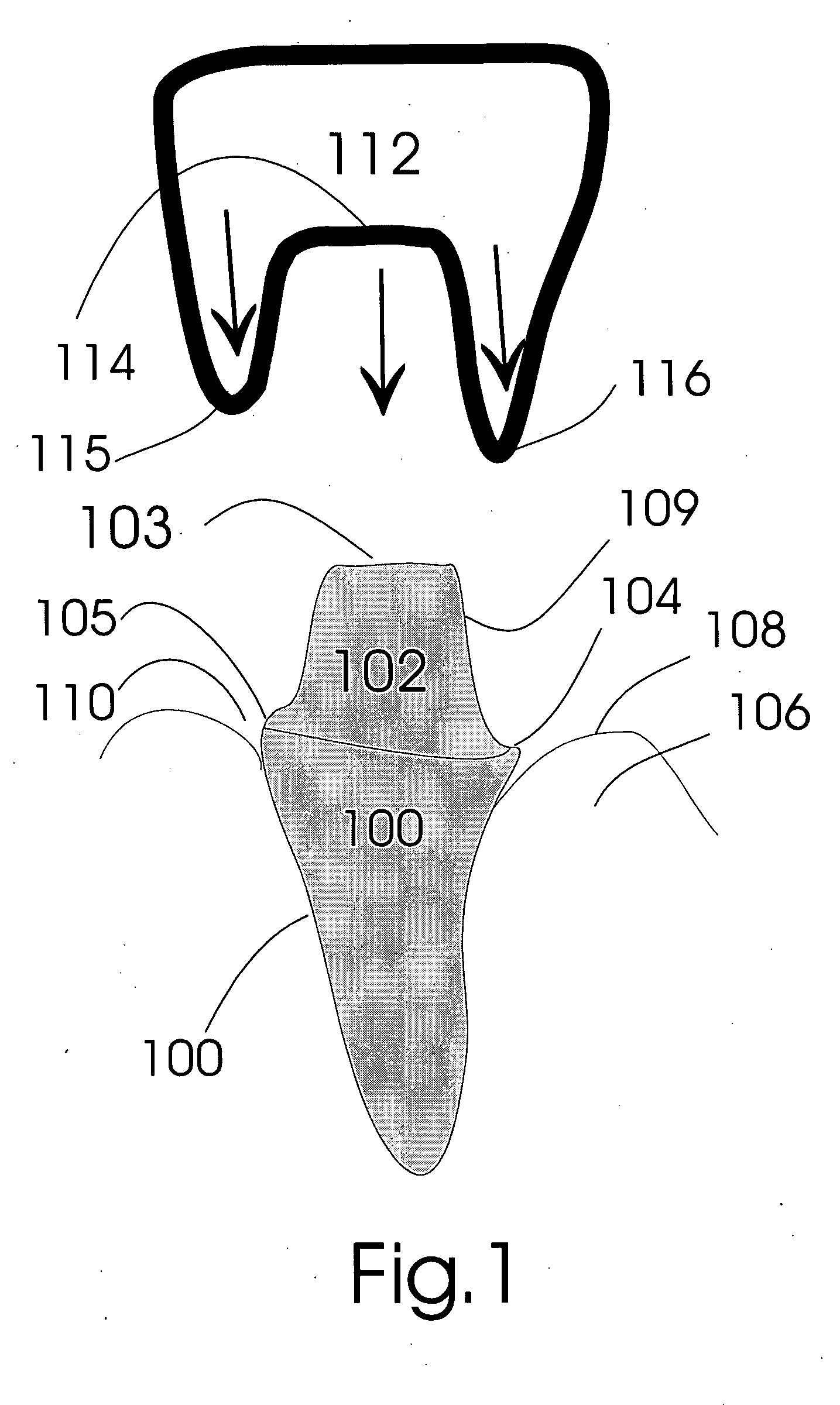 Gingival retraction device and method