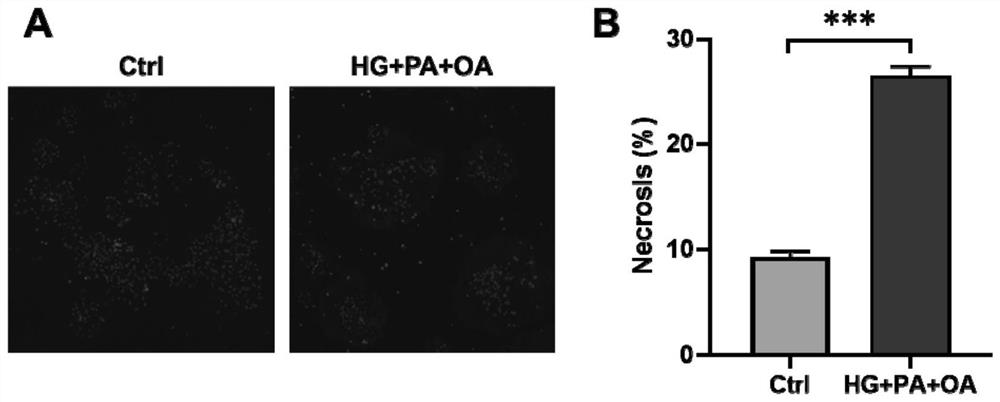 Construction method and application of acute pancreatitis cell model