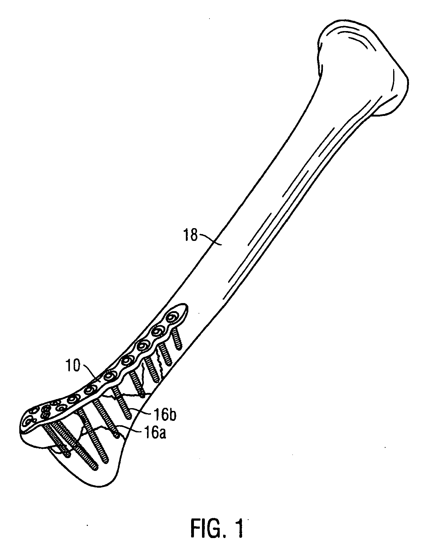 Implantable device, system for generating localised electromagnetic fields in the area of an implant and coil arrangement