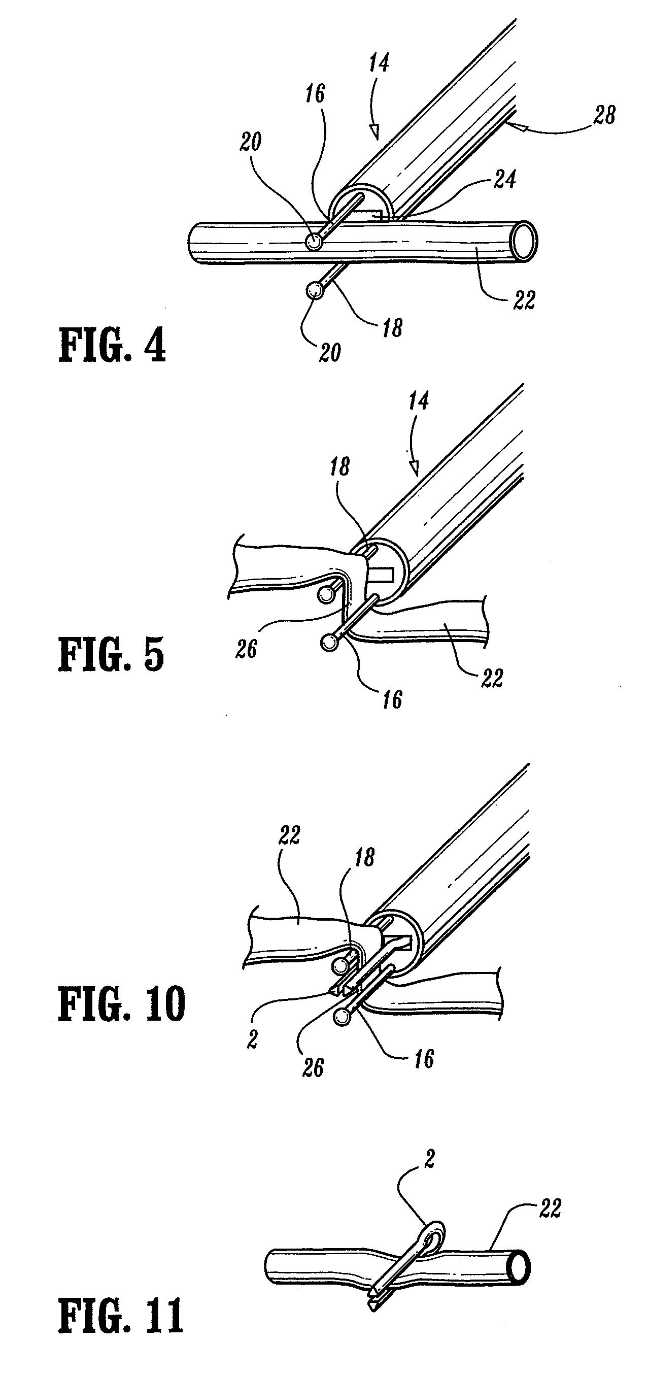 Method for blood vessel clip application