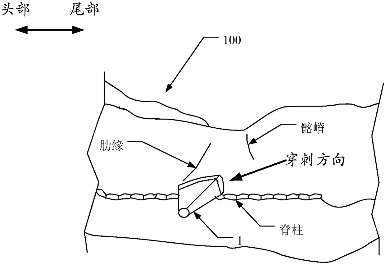 Quadratus lumborum plane block method